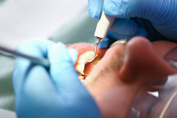 Best Emergency Tooth Extraction in Mount Zion, IL